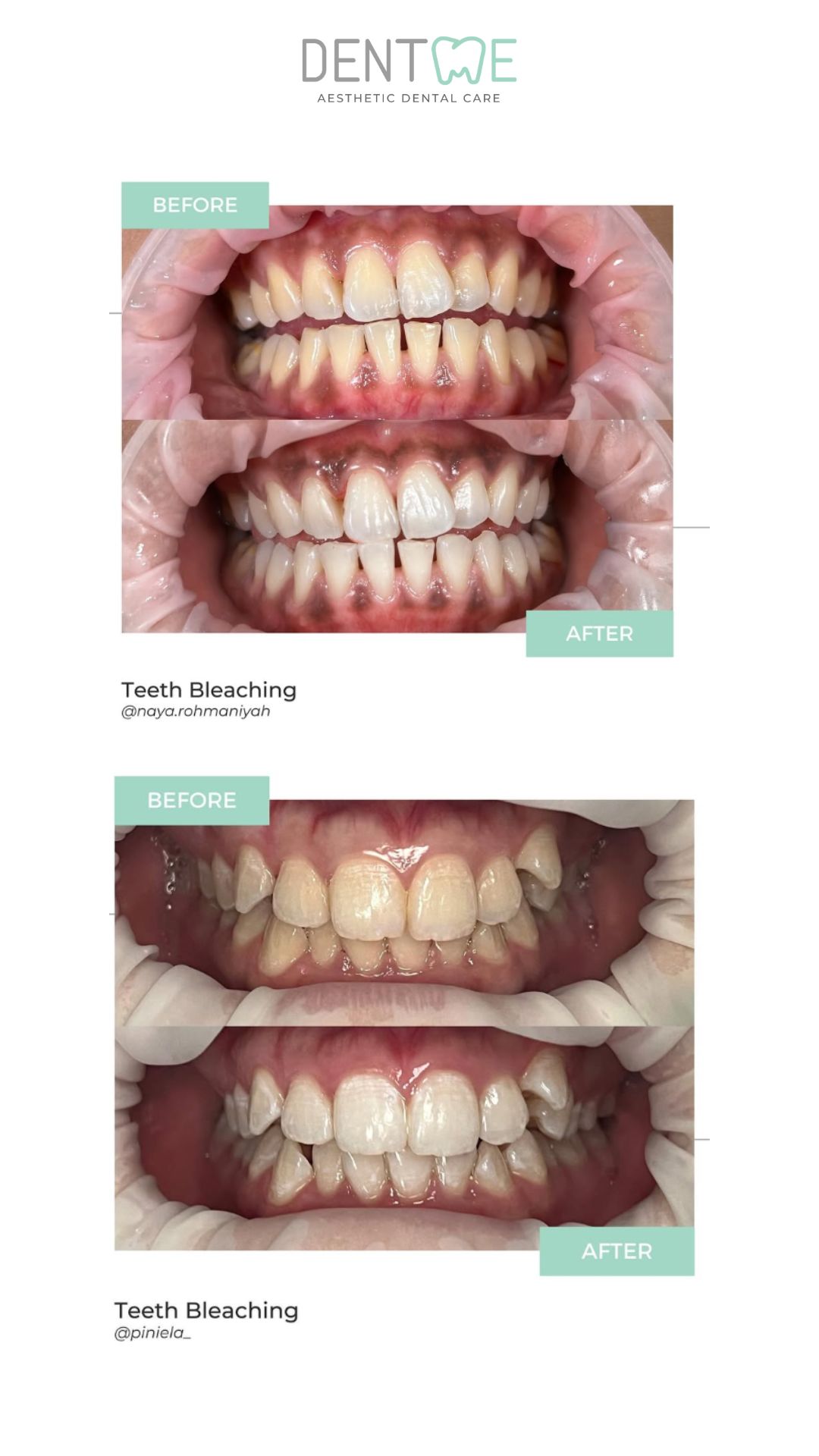 bleaching 4