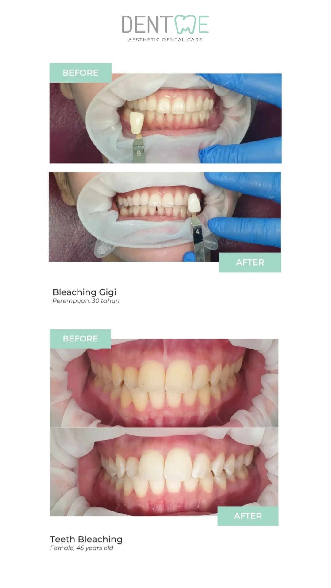 bleaching3